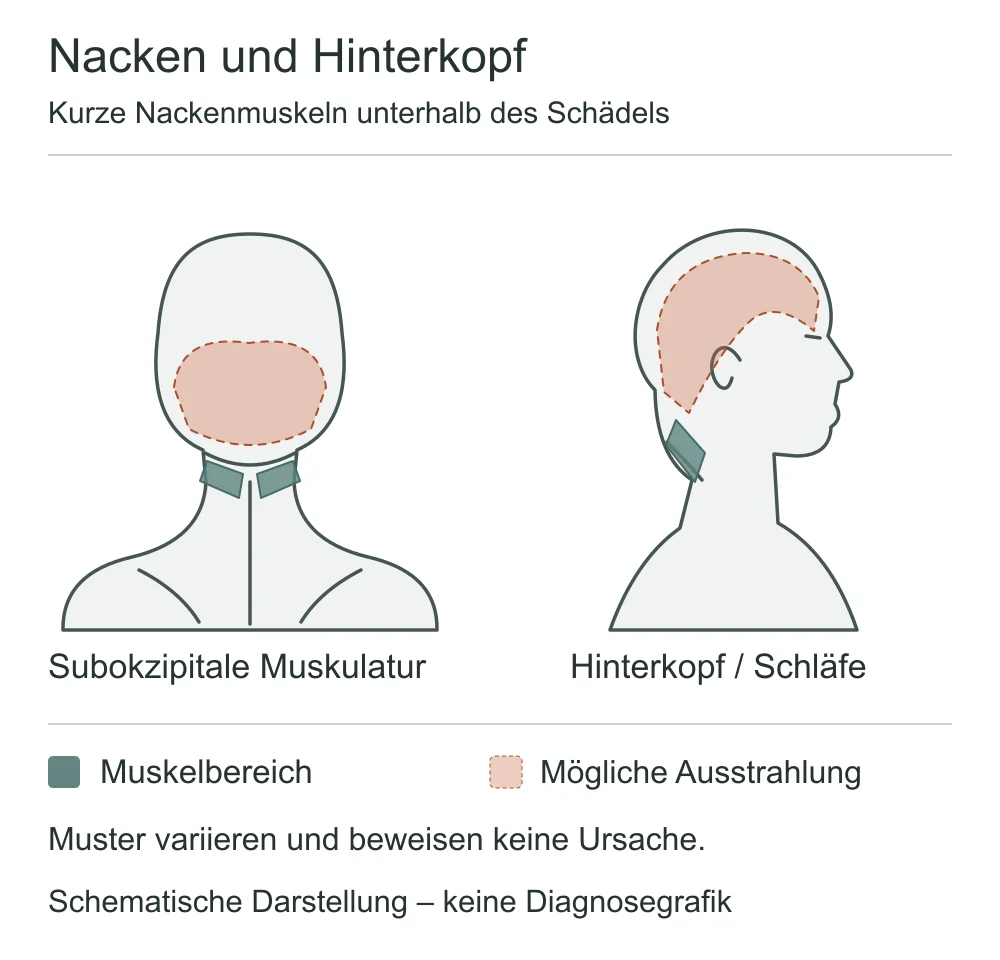 Schema der subokzipitalen Muskeln unterhalb des Hinterkopfs und möglicher Ausstrahlung zu Hinterkopf und Schläfe.